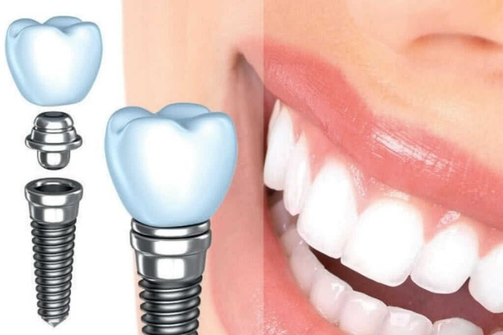 Имплантация зубов: сроки